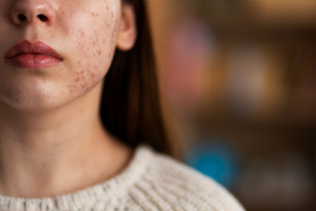 How to Remove Acne Scars Naturally: A Complete Guide