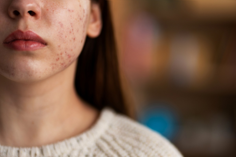How to Remove Acne Scars Naturally: A Complete Guide