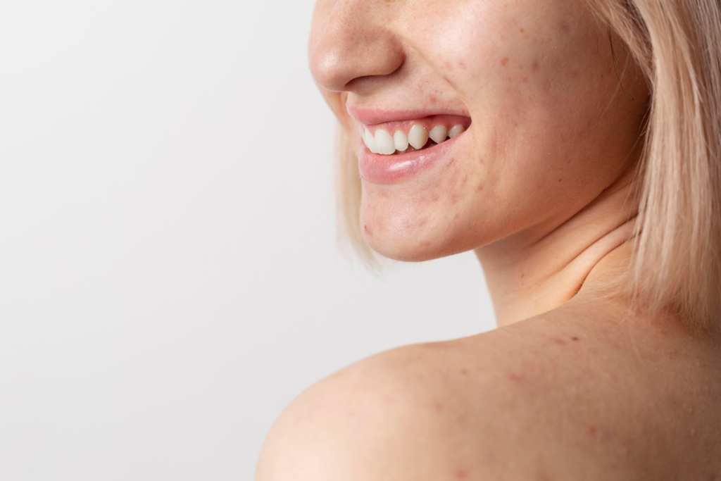 Professional Treatments for Acne Scars That Really Work: Dermatologist-Recommended Solutions