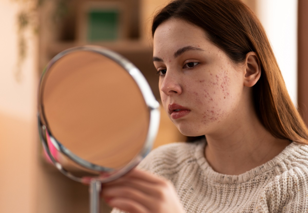 How to Prevent Hormonal Acne: Dermatologist-Approved Strategies for Clearer Skin