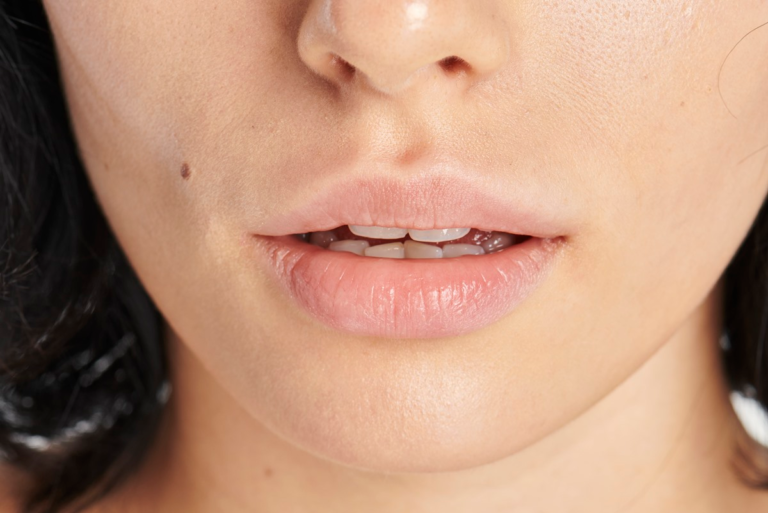 Как убрать носогубные складки: эффективные методы и советы косметолога